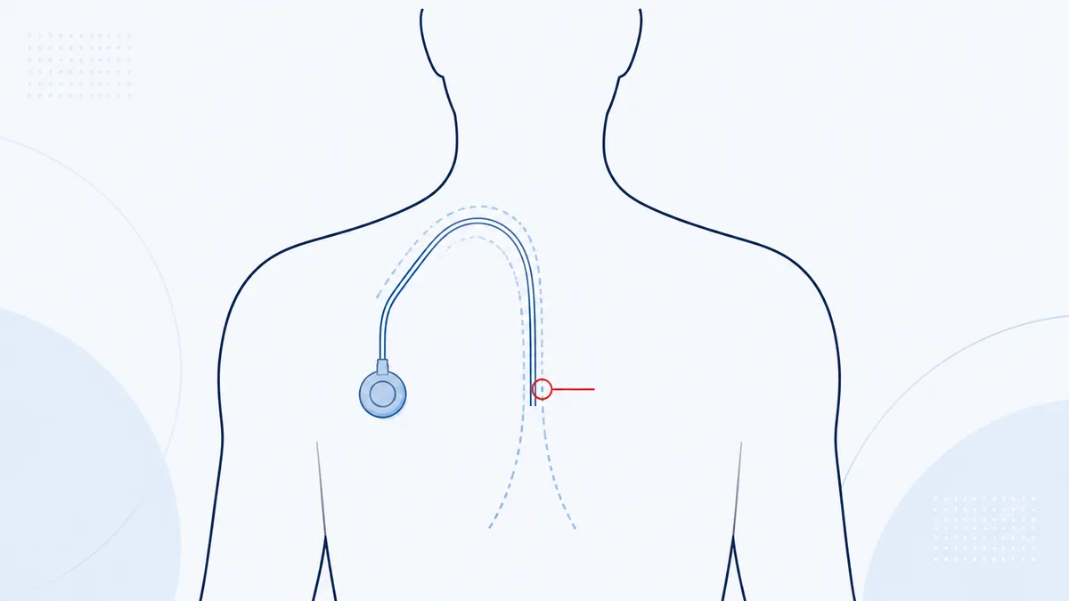Placement diagram of an implanted port catheter in a simplified torso outline, with a break marked in the catheter line